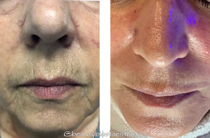 hydrafacial-before-after-client-senior